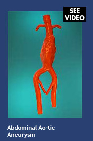 Abdominal Aortic Aneurysm