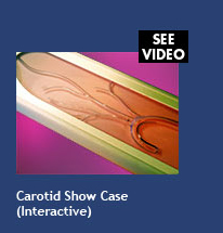 Carotid Show Case (interactive)