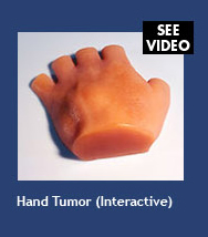 Hand Tumor (interactive)