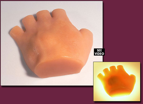Hand Tumor