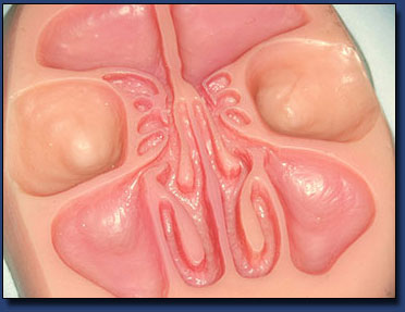 Sinuplasty Sectioned Model