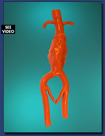 Abdominal Aortic Aneurysm