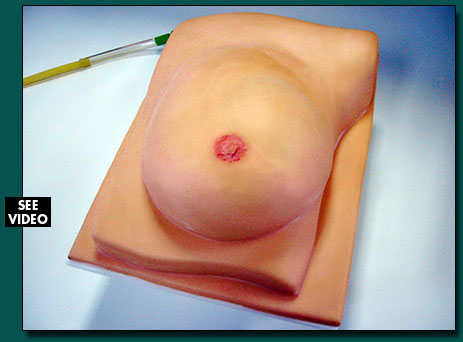 Mastectomy
